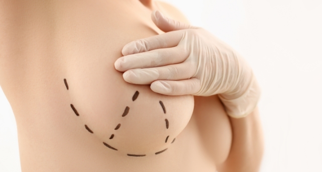 mamoplastia-redutora