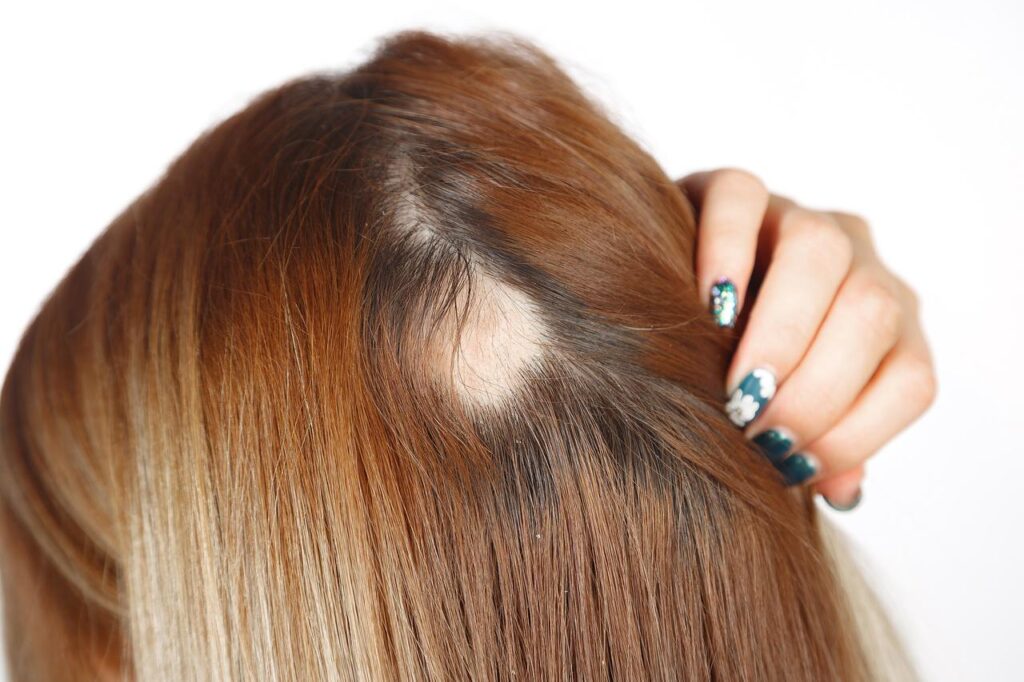 Alopecia- Principal Causa.;