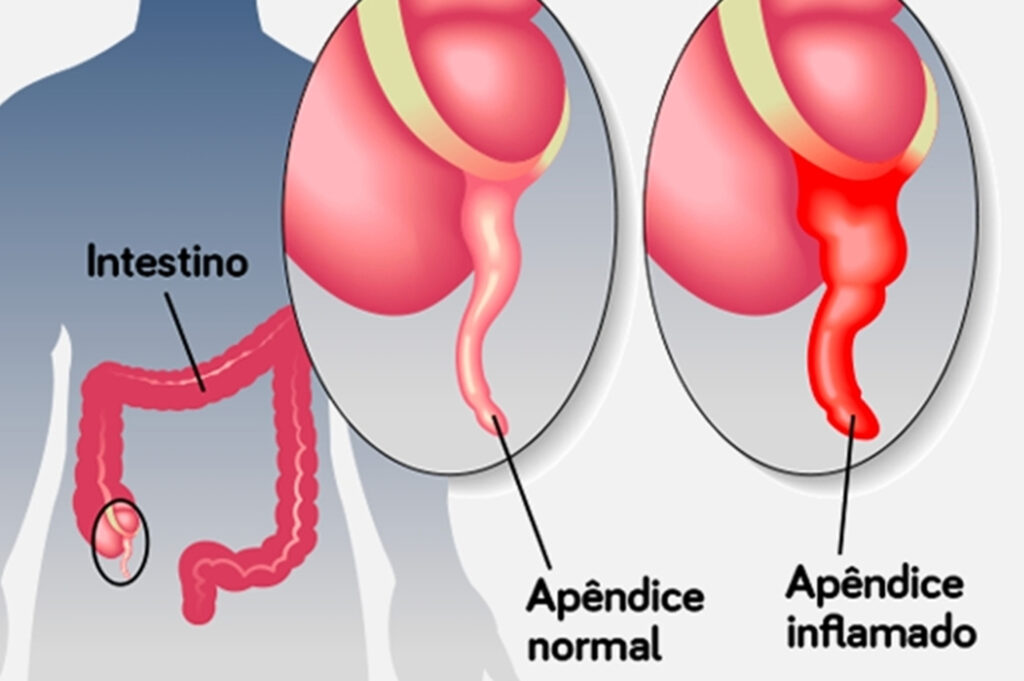 Apendicectomia: O Que é?