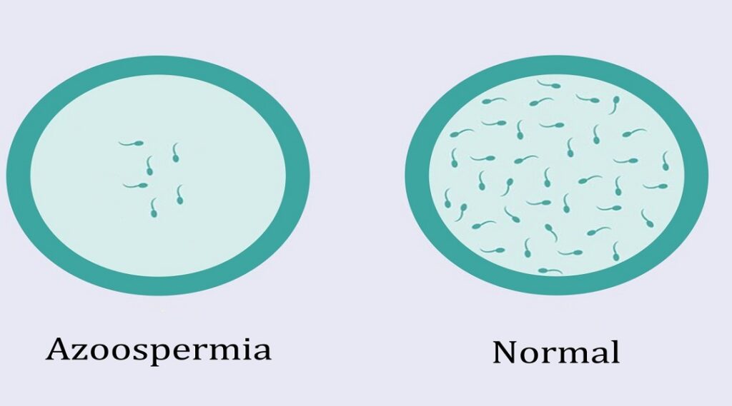 Azoospermia- O Que é, Causas e Tratamentos..