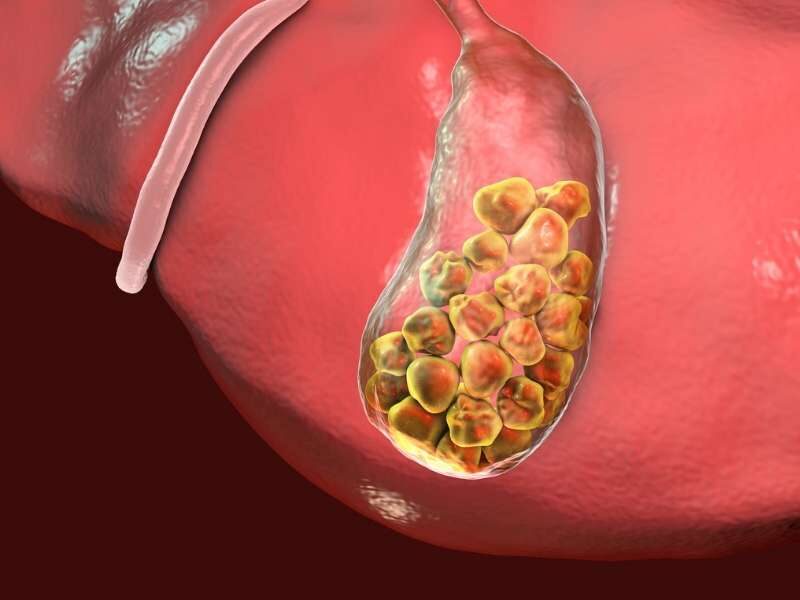 Como Funciona a Cirurgia de Pedra na Vesícula?