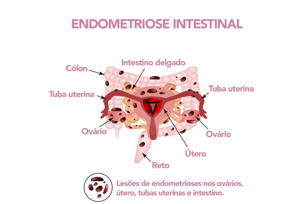 Endometriose Intestinal- O Que é?