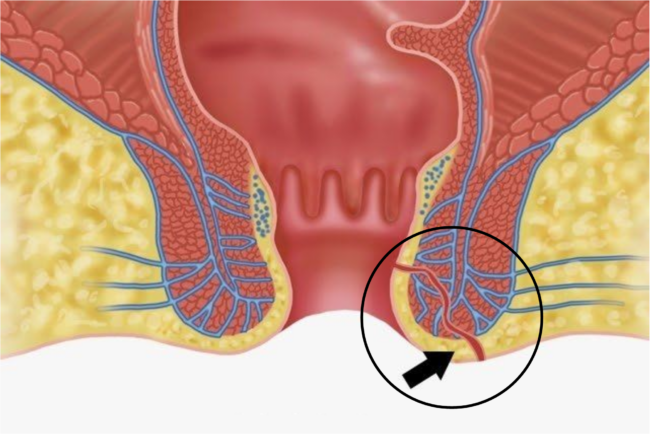 Fistula Anal- O Que é e Como Tratá-la..