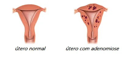 Adenomiose Uterina- O Que é?