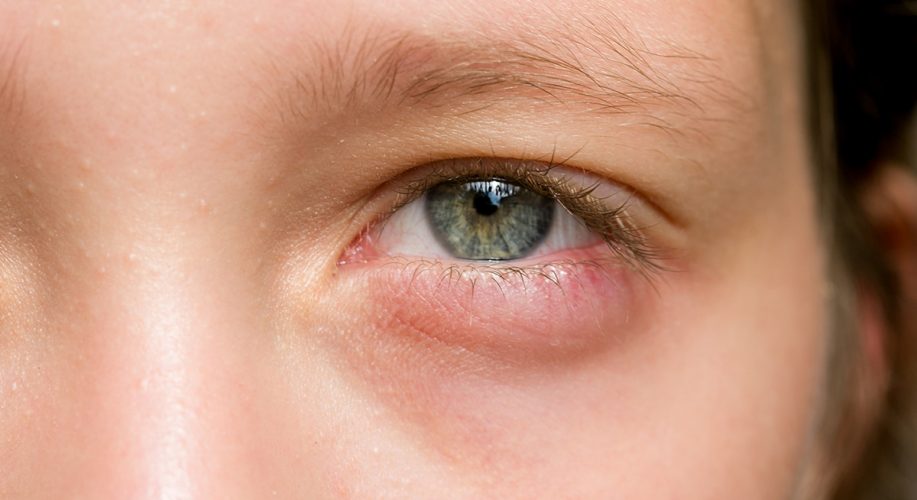 Celulite Ocular- O Que é, Sintomas E Tratamentos.