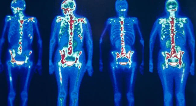Cintilografia óssea- O Que é e Para que Serve?