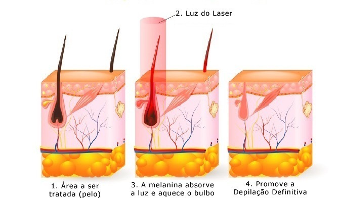 Depilação a Laser na Virilha- Antes e Depois.