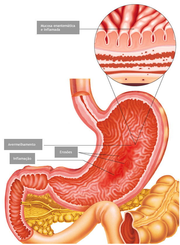 Gastrite- O Que é e quais os sintomas?