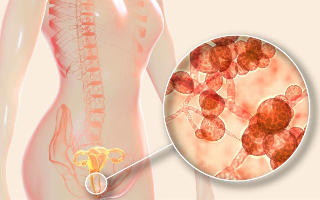 O Que é Candidíase Feminina?;