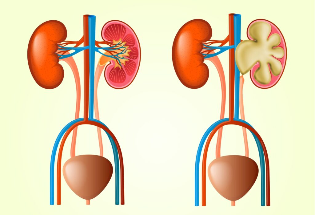 Pieloplastia: O Que é?
